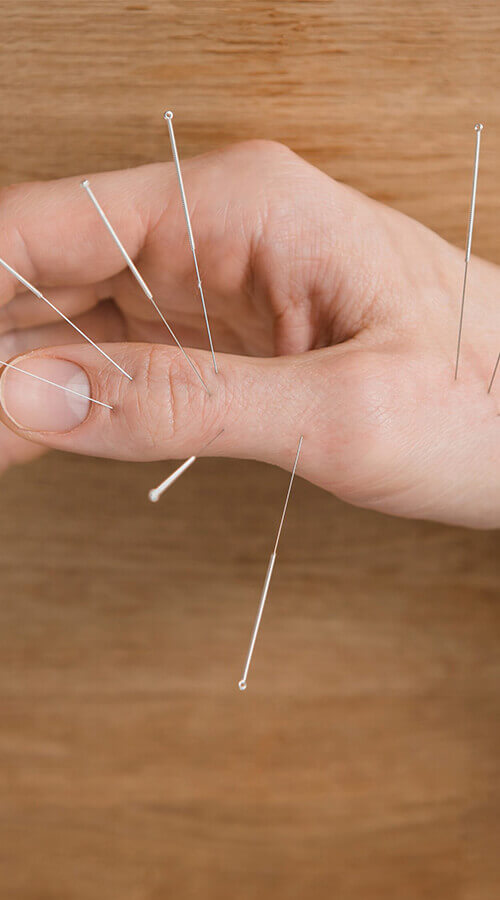 Acupuncture